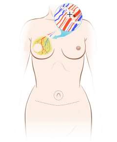 Illustration of blood vessels connected to breast