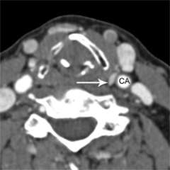 Parathyroid 4D-CT