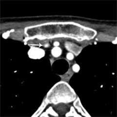 4D-CT Scan