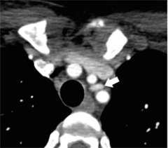 4D-CT Scan