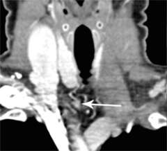 4D-CT Scan