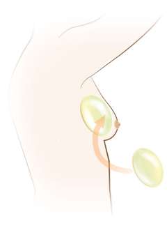 Illustration of implanting an expander