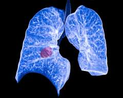 Lung Screening