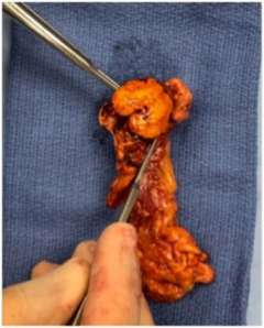 Aldosterone-producing adenoma