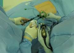 Port used for single-incision retroperitoneoscopic adrenalectomy.