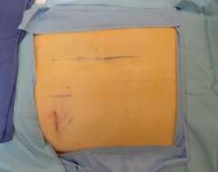 Appearance of scar immediately following single-incision retroperitoneoscopic adrenalectomy.