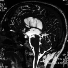 X-ray of brain showing Aquiductal Stenosis