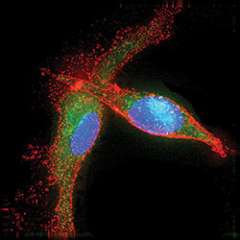 Brain Tumor Dendritic Cell Eating Cancer