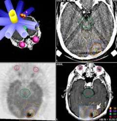Stereotactic radiosurgery