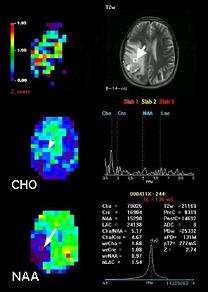 MRI of brain