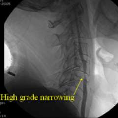 Carotid Stenting Fig 1