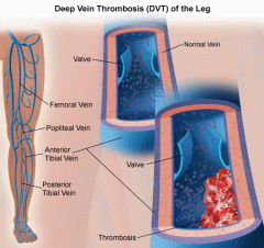 Deep Vein Thrombosis of the Leg