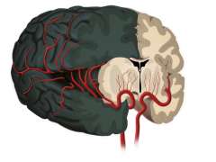 hemispherectomy