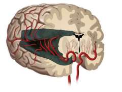 functional hemispherectomy