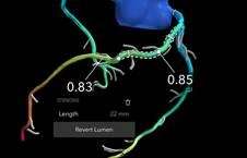 Borderline Stenosis