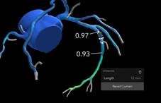 Focal Stenosis