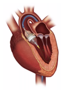 Transcatheter Aortic Valve Replacement Procedure