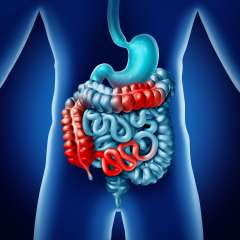 Inflammatory Bowel Diseases (IBD)