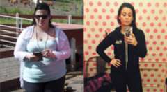 Kalista Gastric Sleeve