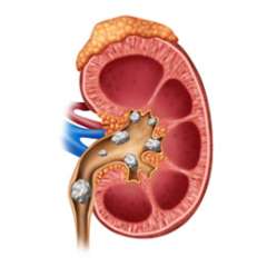 Kidney Stones Illustration