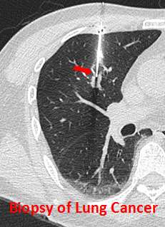 Biopsy of lung cancer