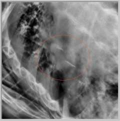 lung