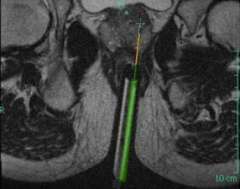 Oblique Axial T2-weighted image