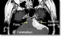 Meningioma Cerebellopontine Angle