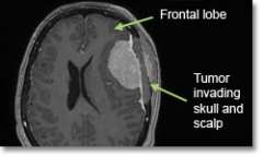 Meningioma Convexity