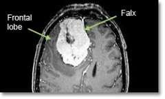 Meningioma Parafalcine