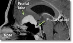 Meningioma Olfactory Groove and Sella