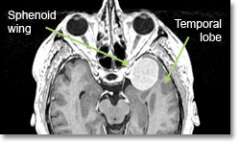 Meningioma Sphen
