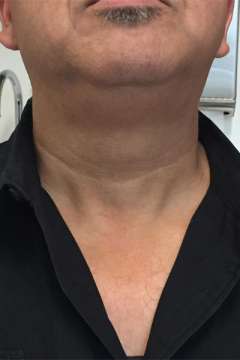 Scar after parathyroidectomy