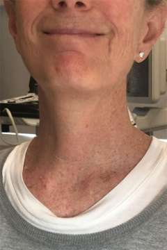 Scar after parathyroidectomy