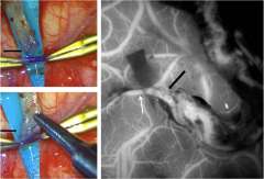 Moyamoya Anastamosis collage