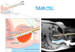 Pivotal Study of MRI-guided Transurethral US Ablation to Treat Localized Prostate Cancer