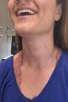 scar after thyroid cancer surgery