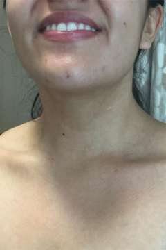 Scar after thyroid cancer surgery