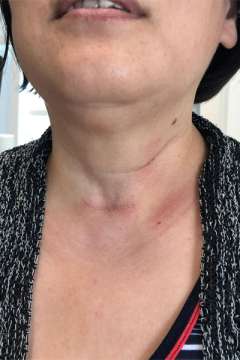 Scar after thyroid cancer surgery