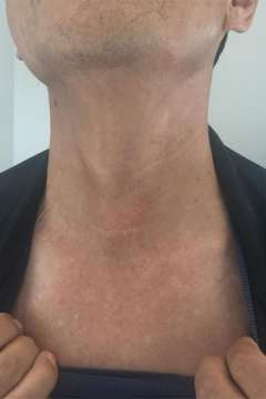 Scar after thyroid cancer surgery