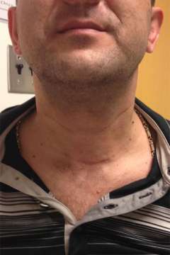 Scar after thyroid cancer surgery