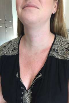 Scar after total thyroidectomy