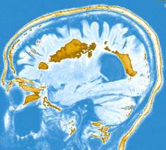 MRI of the brain showing multiple lesions