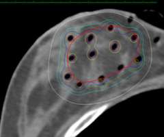 breast cancer