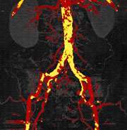 dual energy after bone removal