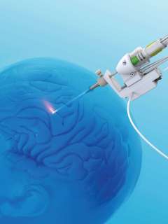 Laser ablation 