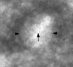 Milk of calcium calcifications