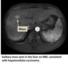 Hepatocellular carcinoma x-ray