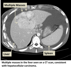 Hepatocellular carcinoma x-ray 2