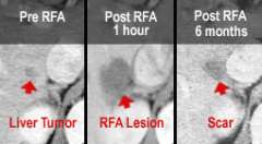 Three step diagram of liver pre-ablation and post-ablation